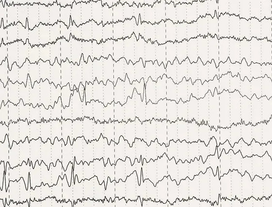 A black and white electroencephalogram (EEG) printout showing multiple wavy lines plotted on a grid. The lines represent electrical activity in the brain, with varying amplitudes and frequencies, indicating different brain wave patterns.